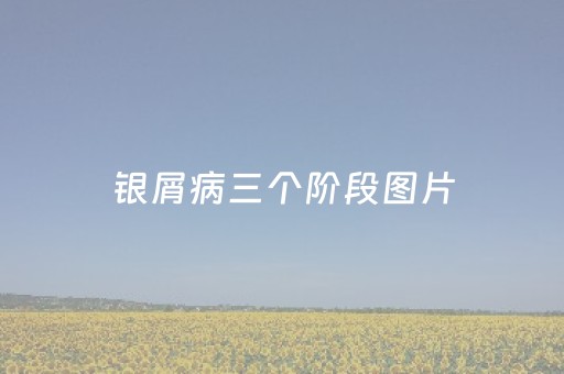 银屑病三个阶段图片（能抠下大块头屑说明了什么）